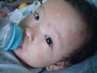赤ちゃんの突発性発疹の症状・画像 - Photo No.2