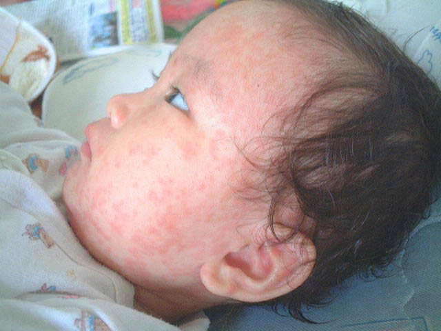 赤ちゃんの突発性発疹の症状 画像